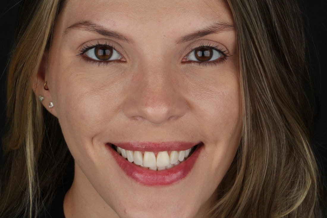 Antes, sorriso natural
